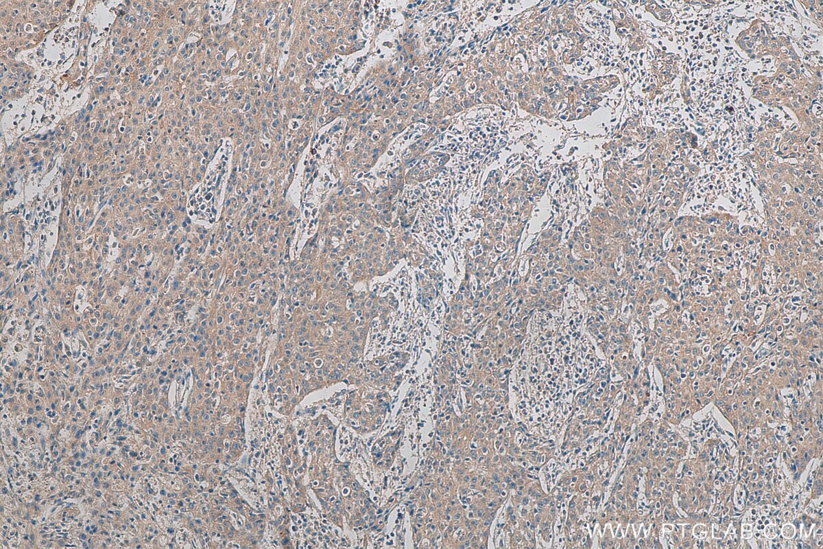 Immunohistochemistry (IHC) staining of human cervical cancer tissue using TMPRSS3 Polyclonal antibody (17953-1-AP)