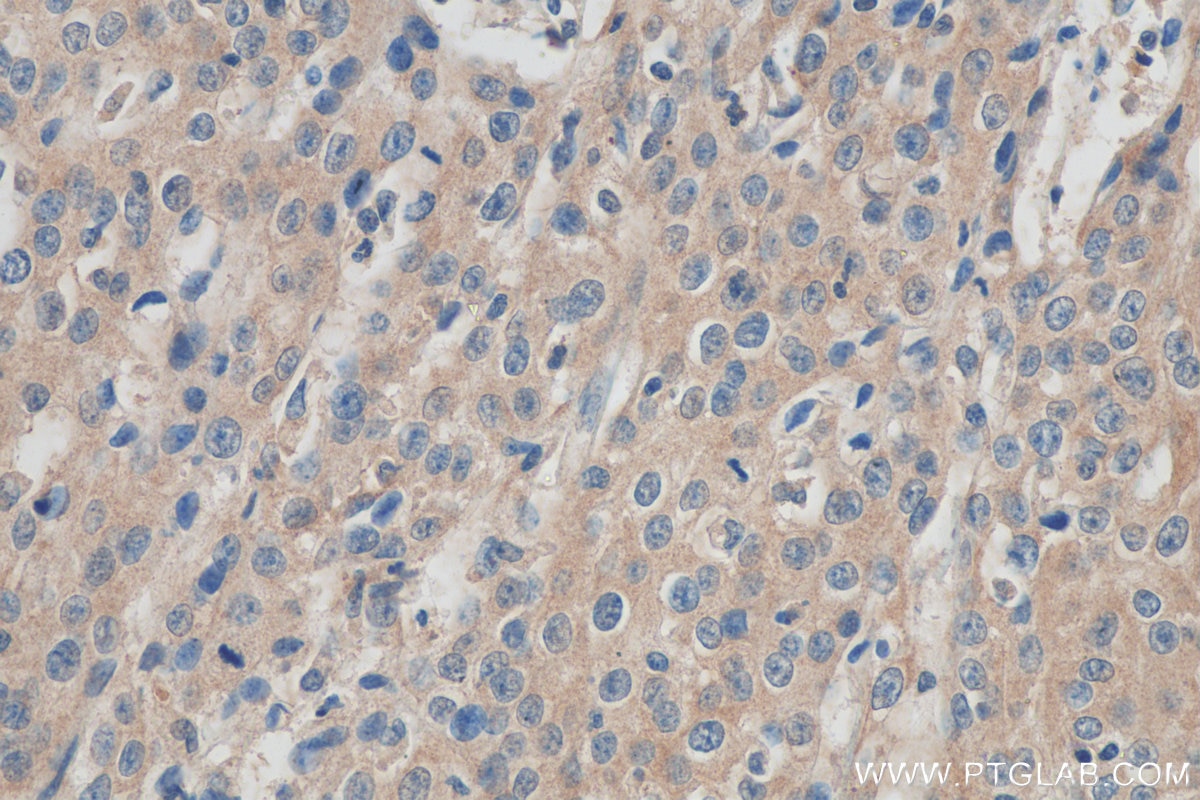 Immunohistochemistry (IHC) staining of human cervical cancer tissue using TMPRSS3 Polyclonal antibody (17953-1-AP)