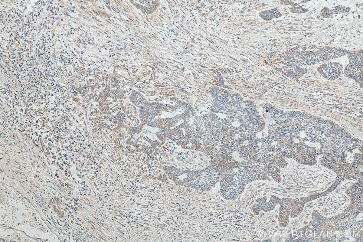 Immunohistochemistry (IHC) staining of human skin cancer tissue using TMPRSS3 Polyclonal antibody (17953-1-AP)