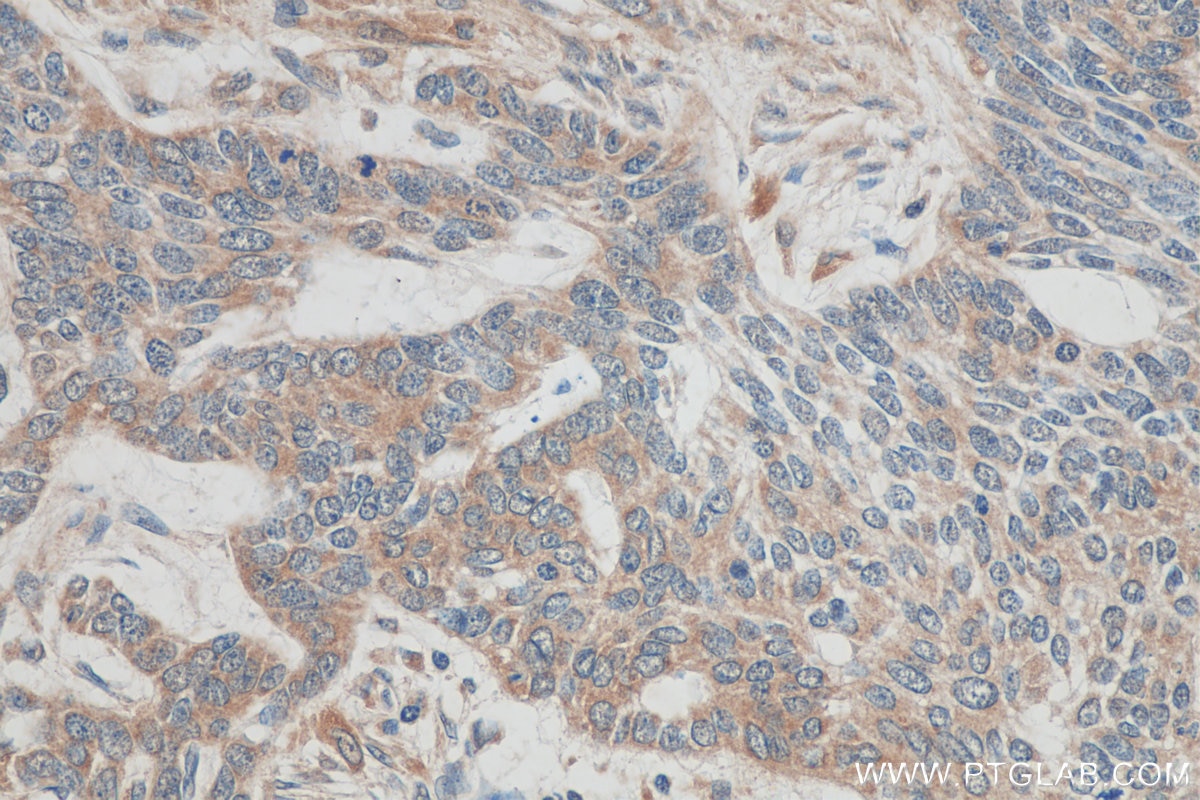 Immunohistochemistry (IHC) staining of human skin cancer tissue using TMPRSS3 Polyclonal antibody (17953-1-AP)