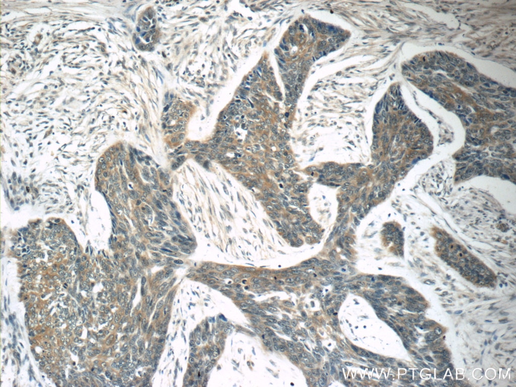 Immunohistochemistry (IHC) staining of human skin cancer tissue using TMPRSS3 Polyclonal antibody (51149-1-AP)