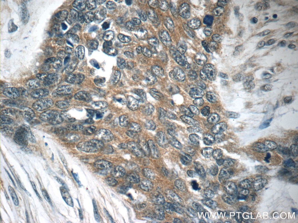 Immunohistochemistry (IHC) staining of human skin cancer tissue using TMPRSS3 Polyclonal antibody (51149-1-AP)