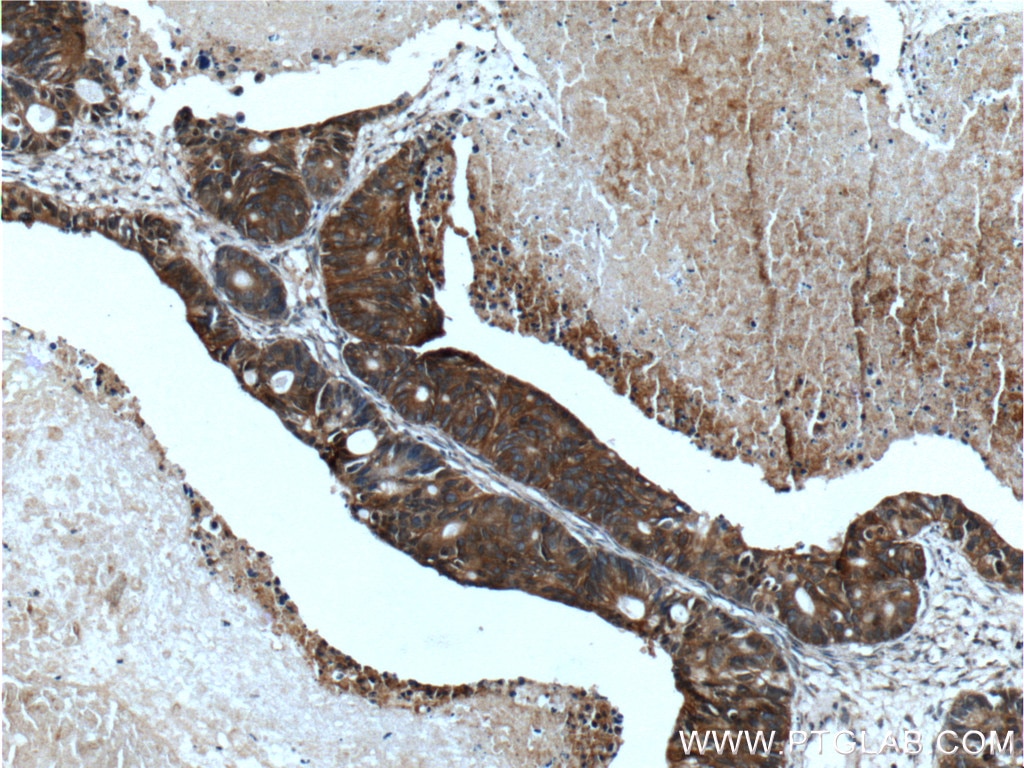 Immunohistochemistry (IHC) staining of human pancreas cancer tissue using TMPRSS4 Polyclonal antibody (11283-1-AP)