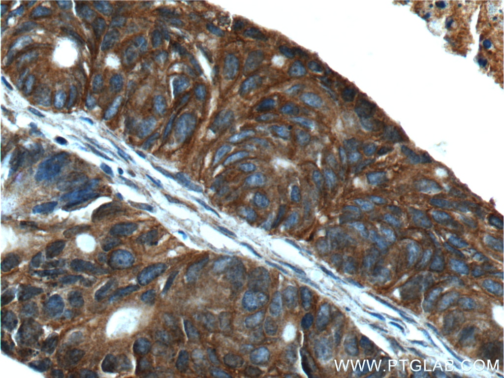 Immunohistochemistry (IHC) staining of human pancreas cancer tissue using TMPRSS4 Polyclonal antibody (11283-1-AP)