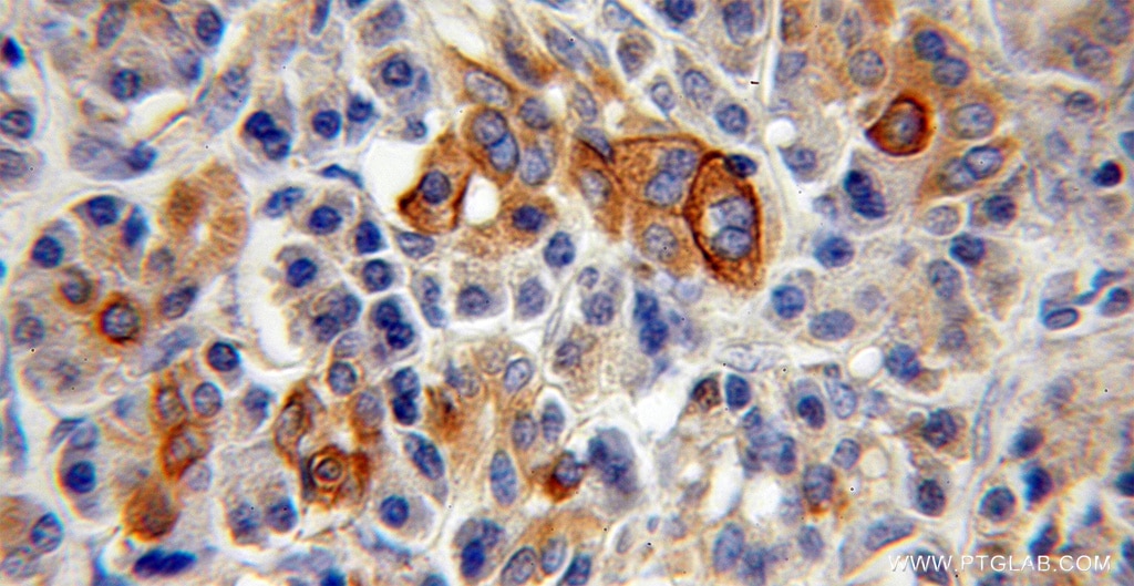 Immunohistochemistry (IHC) staining of human pancreas cancer tissue using TMPRSS4 Polyclonal antibody (11283-1-AP)