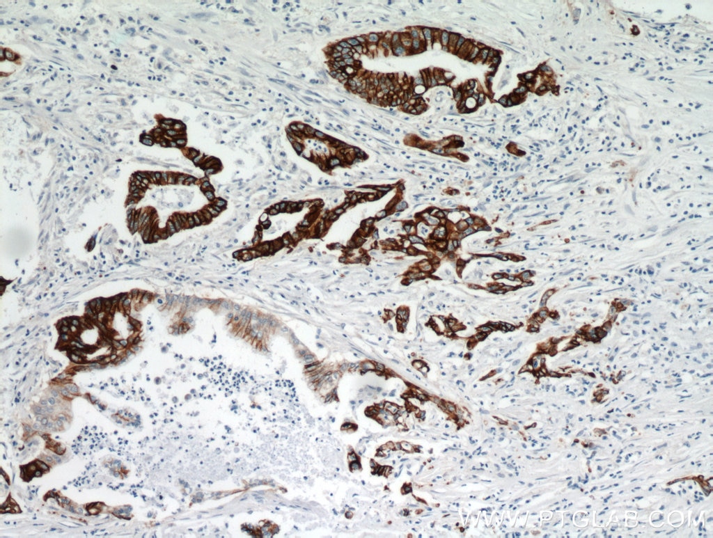 Immunohistochemistry (IHC) staining of human pancreas cancer tissue using TMPRSS4 Polyclonal antibody (11283-1-AP)
