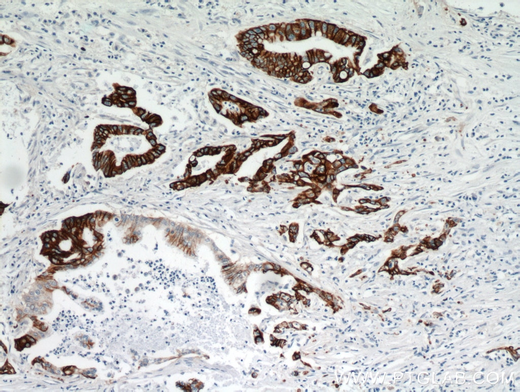 Immunohistochemistry (IHC) staining of human pancreas cancer tissue using TMPRSS4 Polyclonal antibody (11283-1-AP)