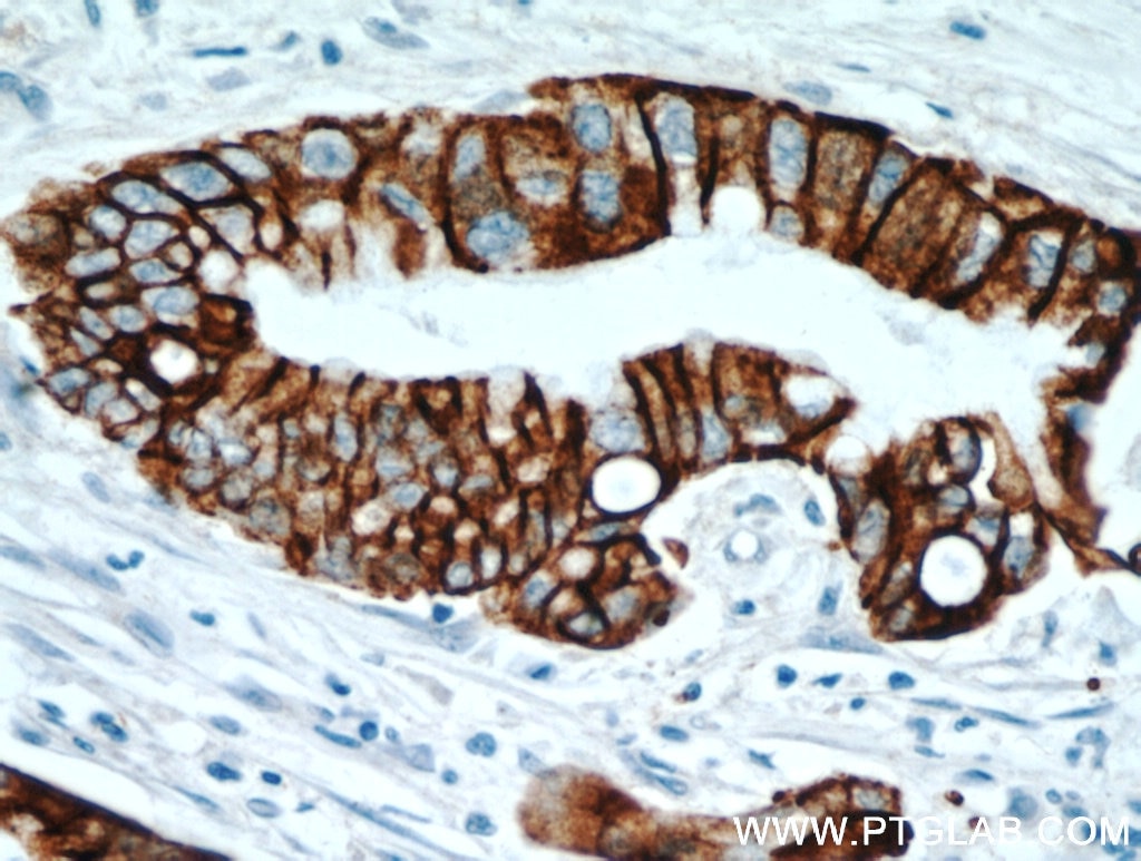 Immunohistochemistry (IHC) staining of human pancreas cancer tissue using TMPRSS4 Polyclonal antibody (11283-1-AP)