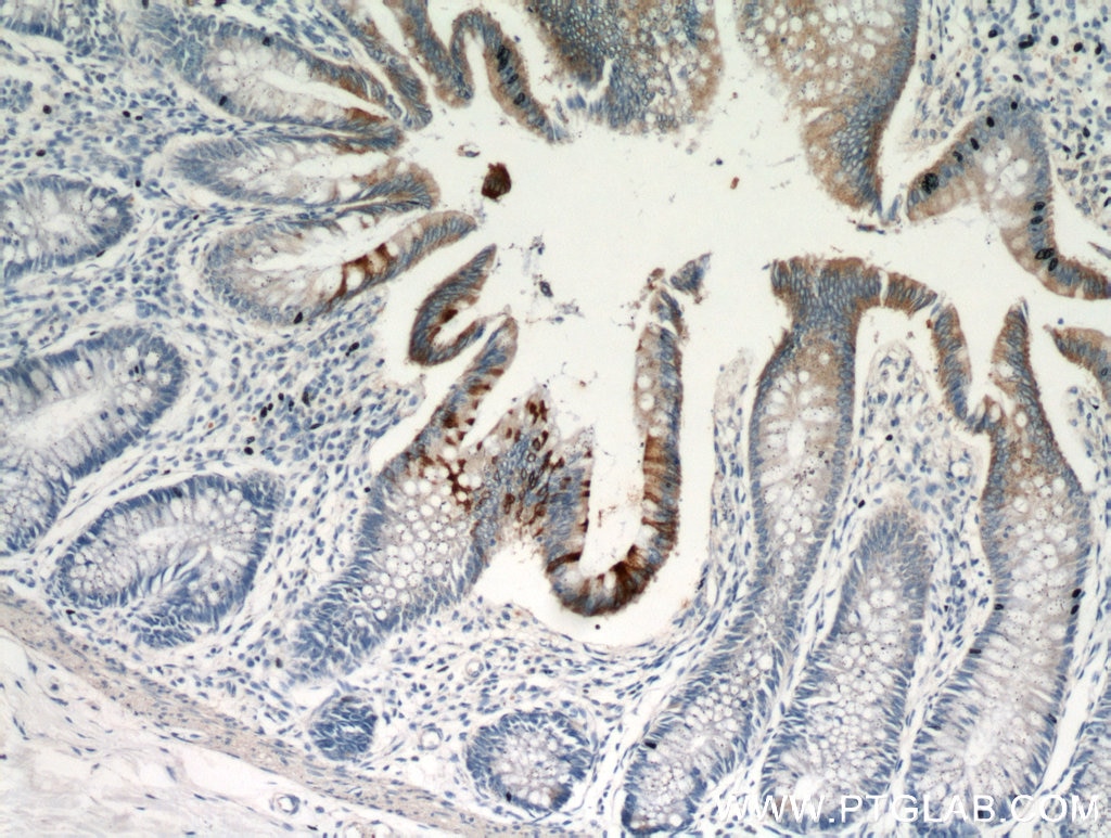 Immunohistochemistry (IHC) staining of human colon tissue using TMPRSS4 Polyclonal antibody (11283-1-AP)