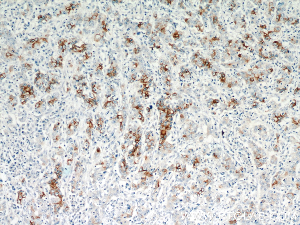Immunohistochemistry (IHC) staining of human stomach cancer tissue using TMPRSS4 Polyclonal antibody (11283-1-AP)