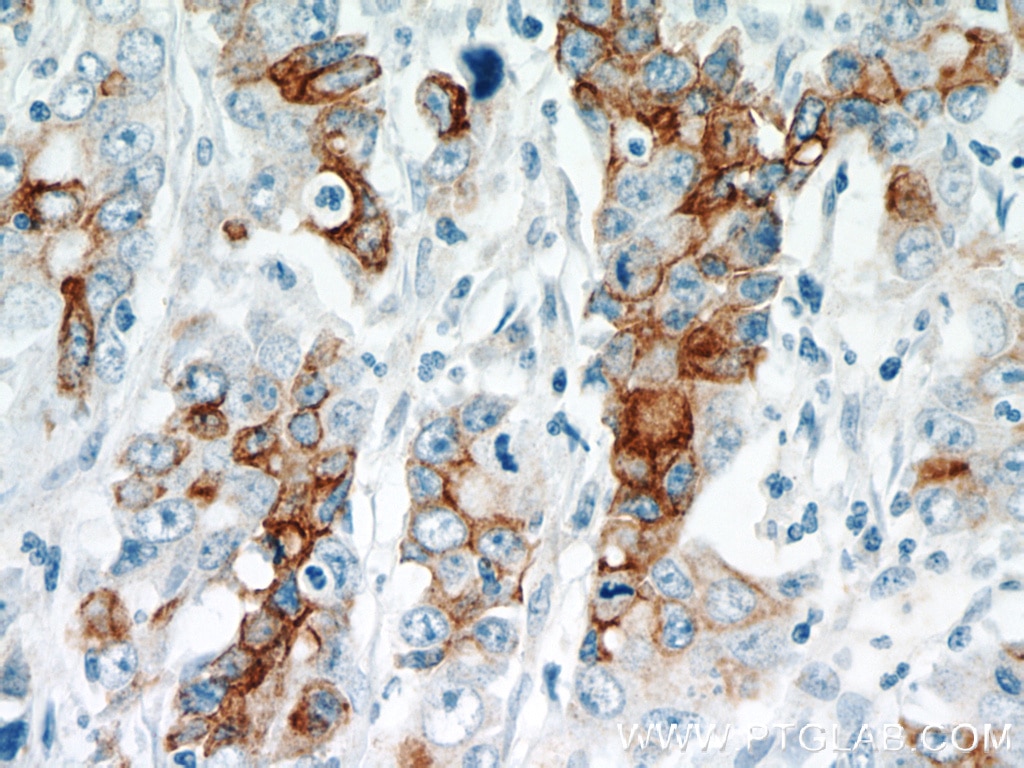 Immunohistochemistry (IHC) staining of human stomach cancer tissue using TMPRSS4 Polyclonal antibody (11283-1-AP)