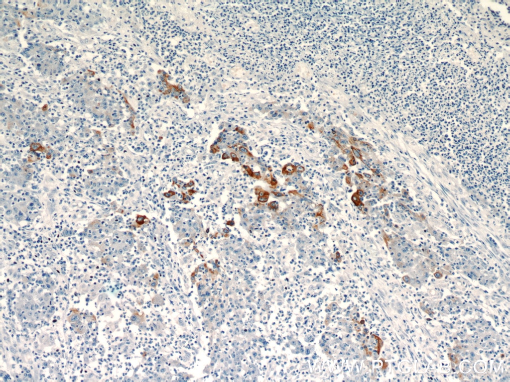 IHC staining of human colon cancer using 11283-1-AP