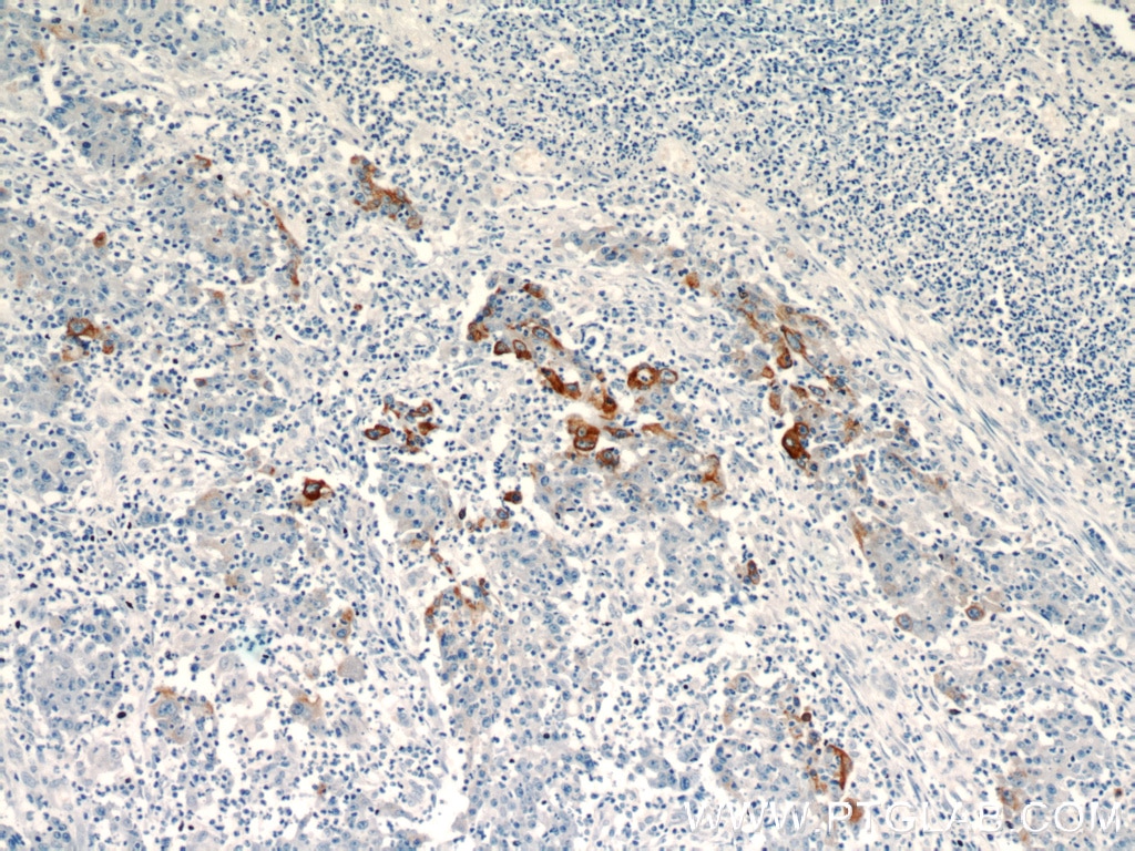 Immunohistochemistry (IHC) staining of human colon cancer tissue using TMPRSS4 Polyclonal antibody (11283-1-AP)