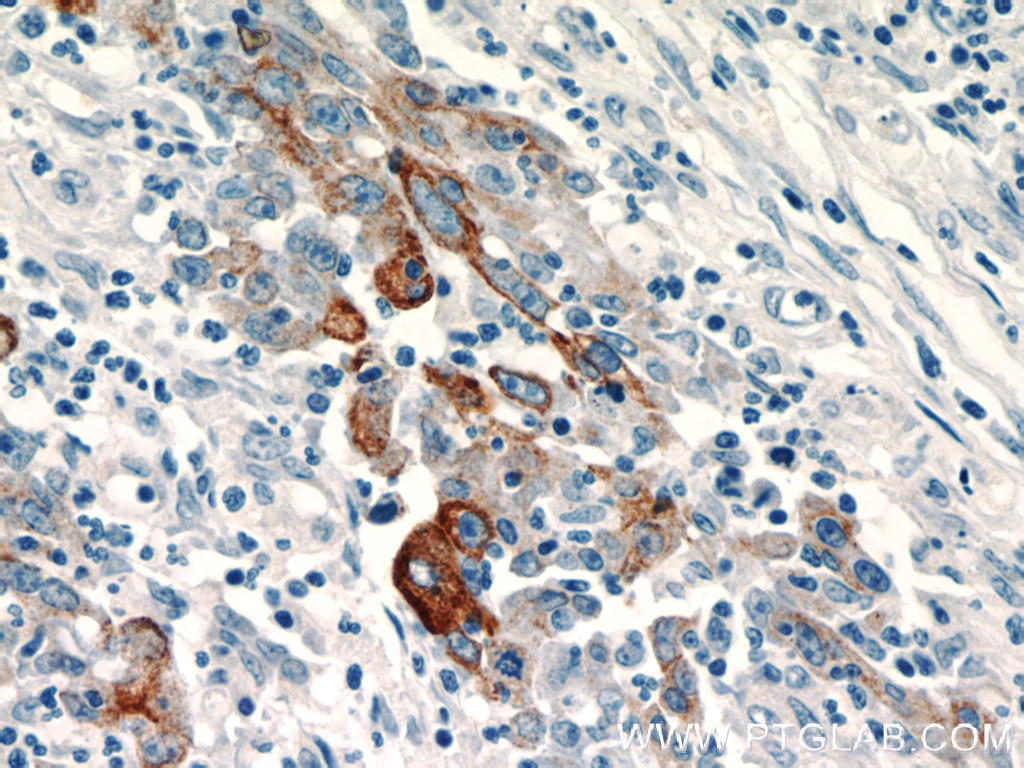 Immunohistochemistry (IHC) staining of human colon cancer tissue using TMPRSS4 Polyclonal antibody (11283-1-AP)