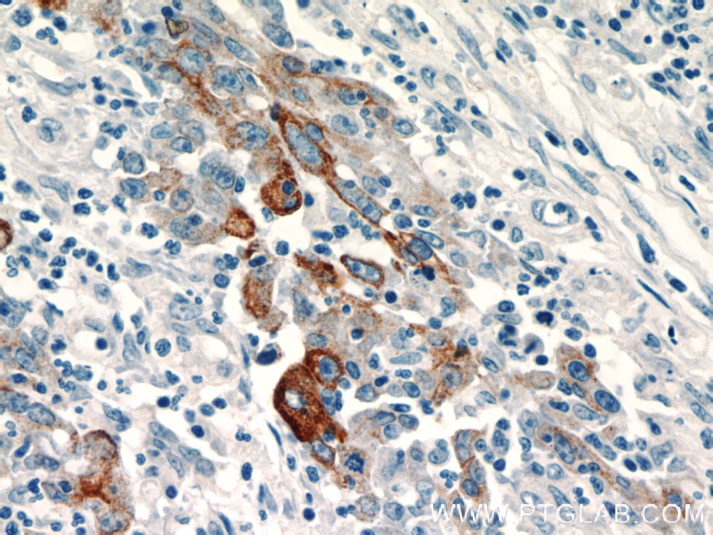 IHC staining of human colon cancer using 11283-1-AP