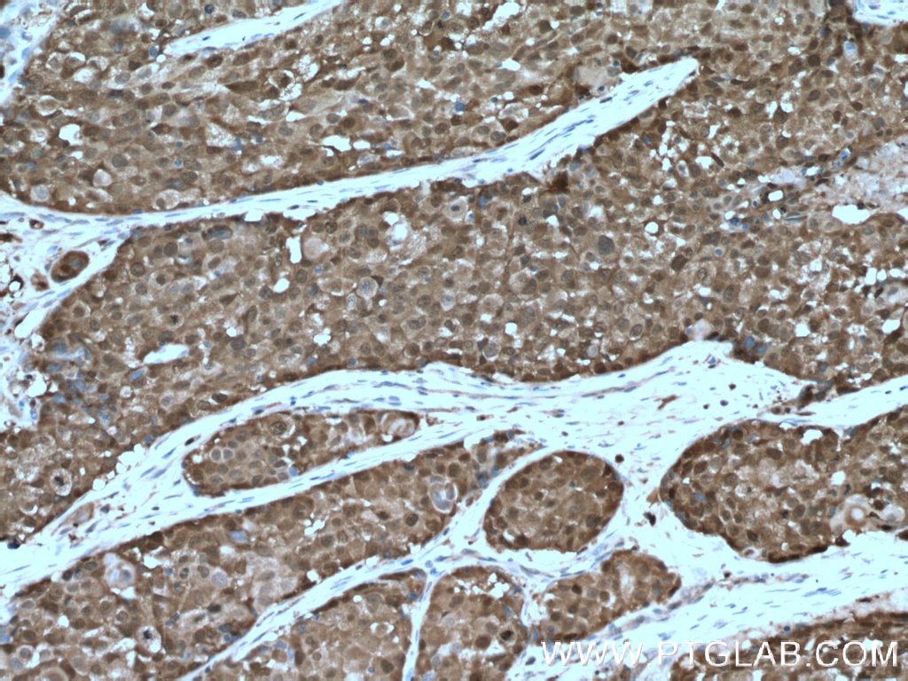 Immunohistochemistry (IHC) staining of human lung cancer tissue using ASC/TMS1 Polyclonal antibody (10500-1-AP)