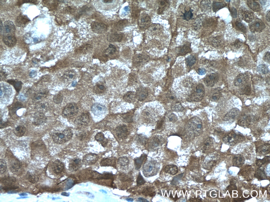 IHC staining of human lung cancer using 10500-1-AP