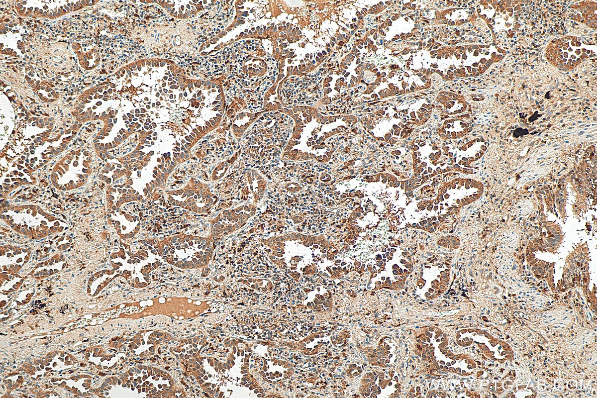 Immunohistochemistry (IHC) staining of human lung cancer tissue using ASC/TMS1 Polyclonal antibody (10500-1-AP)