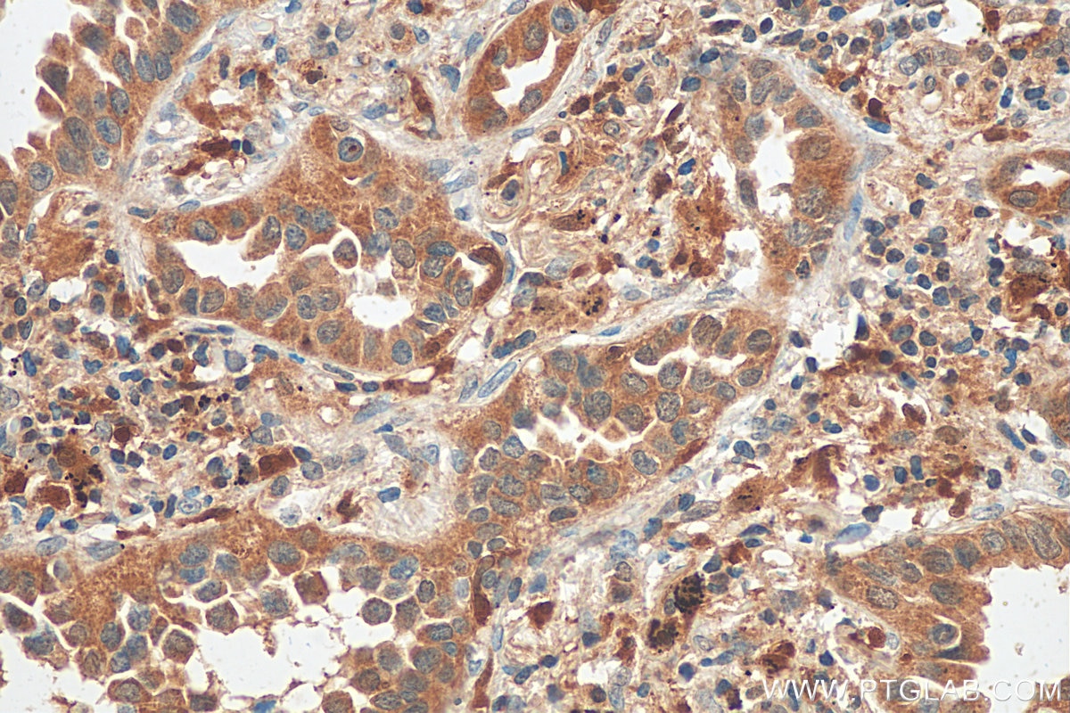 Immunohistochemistry (IHC) staining of human lung cancer tissue using ASC/TMS1 Polyclonal antibody (10500-1-AP)
