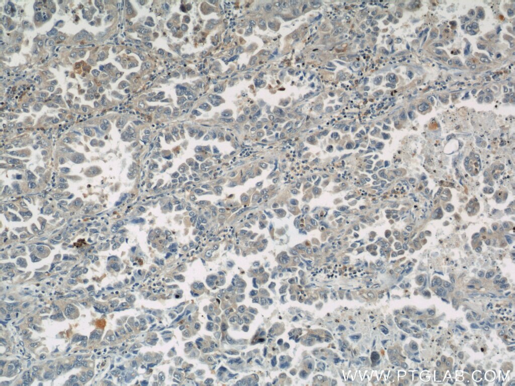 Immunohistochemistry (IHC) staining of human lung cancer tissue using ASC/TMS1 Polyclonal antibody (10500-1-AP)