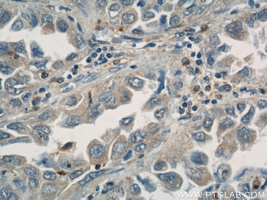 IHC staining of human lung cancer using 10500-1-AP
