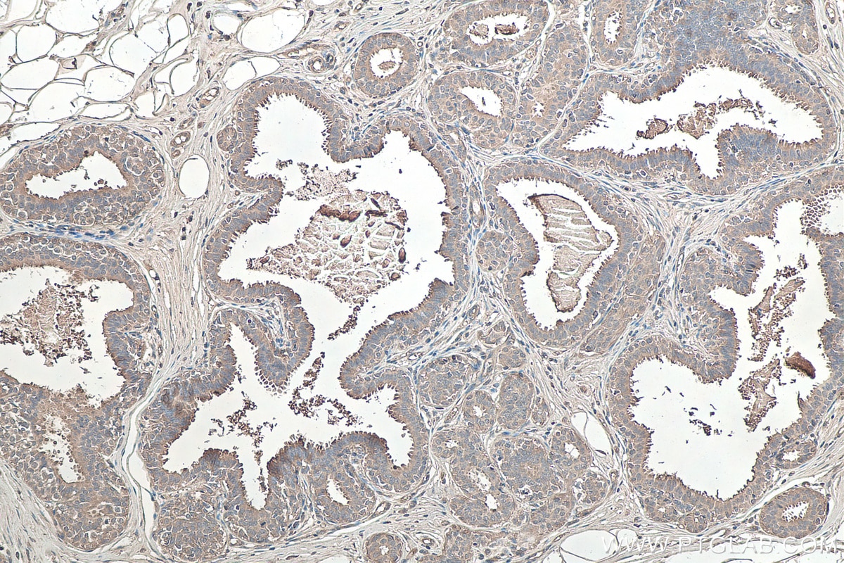Immunohistochemistry (IHC) staining of human breast cancer tissue using TNC/Tenascin-C Monoclonal antibody (67710-1-Ig)
