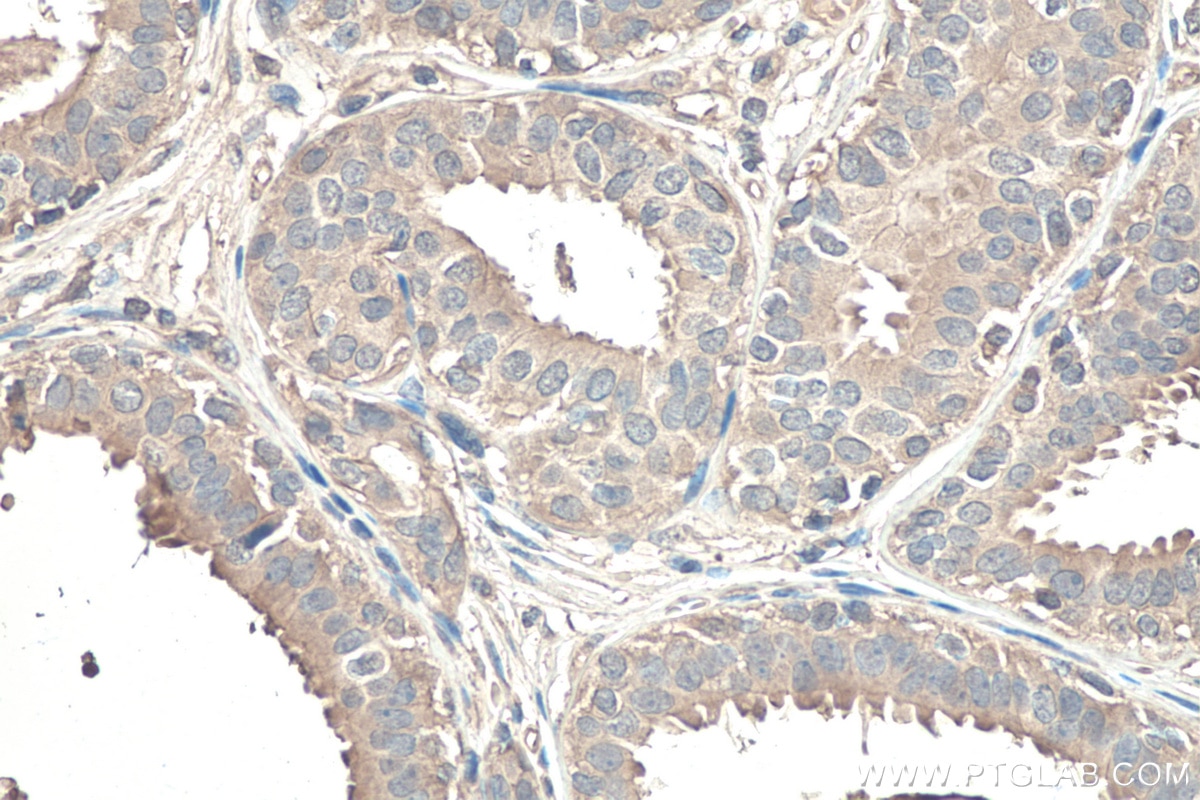 Immunohistochemistry (IHC) staining of human breast cancer tissue using TNC/Tenascin-C Monoclonal antibody (67710-1-Ig)