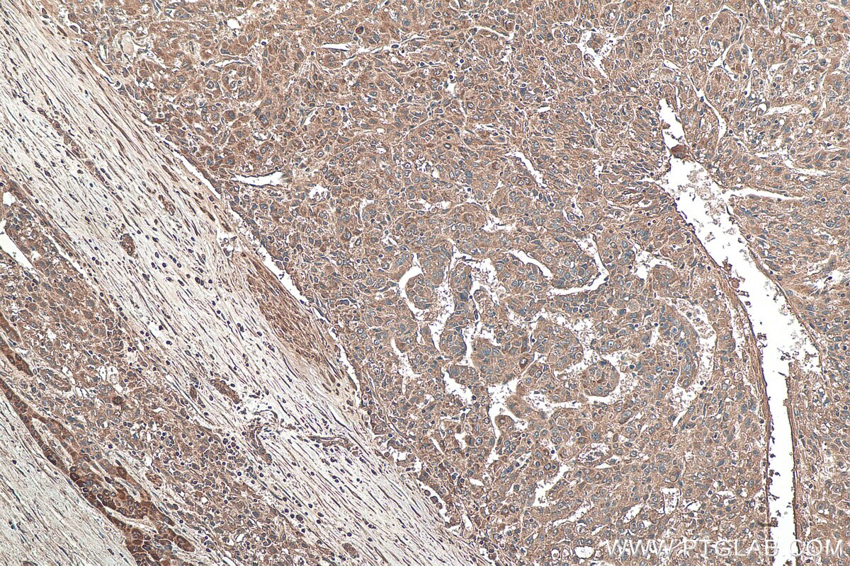 Immunohistochemistry (IHC) staining of human liver cancer tissue using TNC/Tenascin-C Monoclonal antibody (67710-1-Ig)