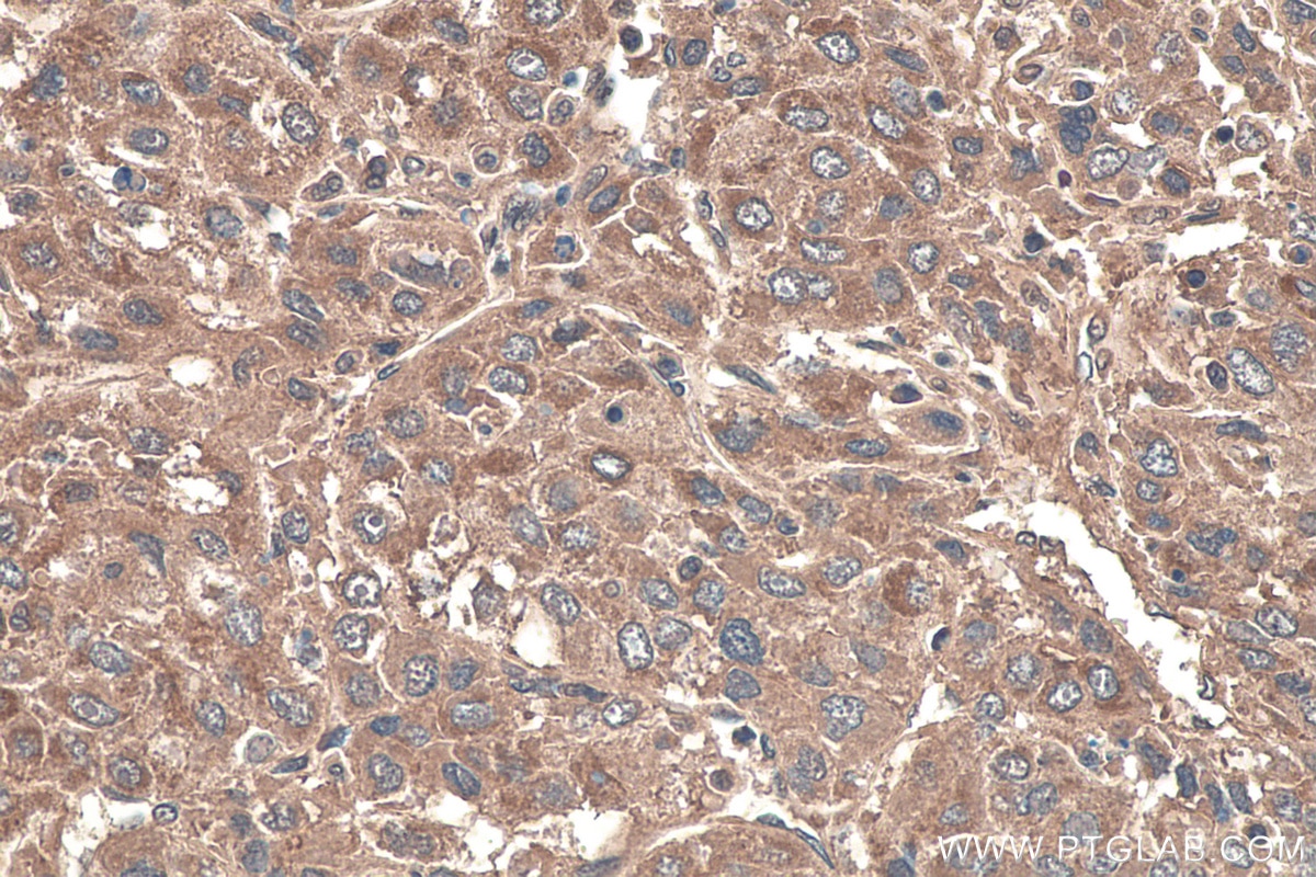 Immunohistochemistry (IHC) staining of human liver cancer tissue using TNC/Tenascin-C Monoclonal antibody (67710-1-Ig)