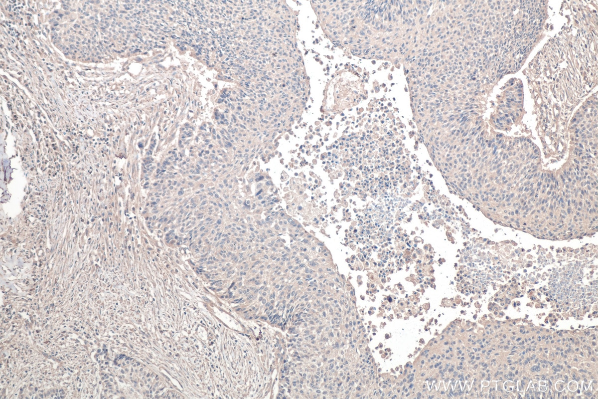 Immunohistochemistry (IHC) staining of human lung cancer tissue using TNC/Tenascin-C Monoclonal antibody (67710-1-Ig)