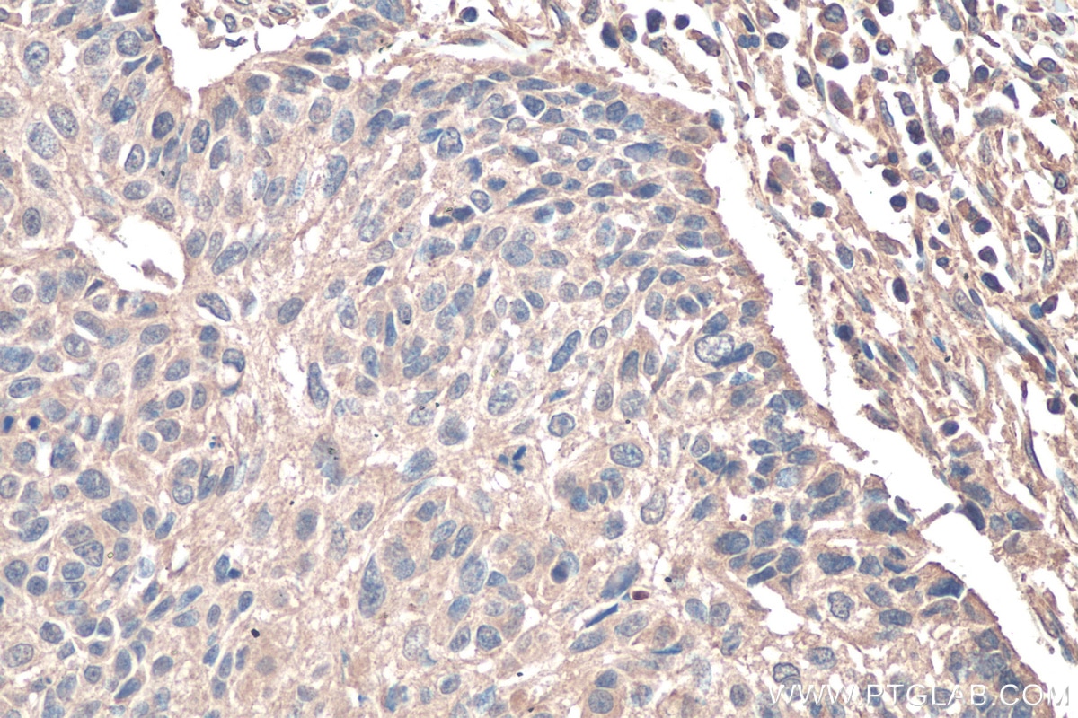 Immunohistochemistry (IHC) staining of human lung cancer tissue using TNC/Tenascin-C Monoclonal antibody (67710-1-Ig)