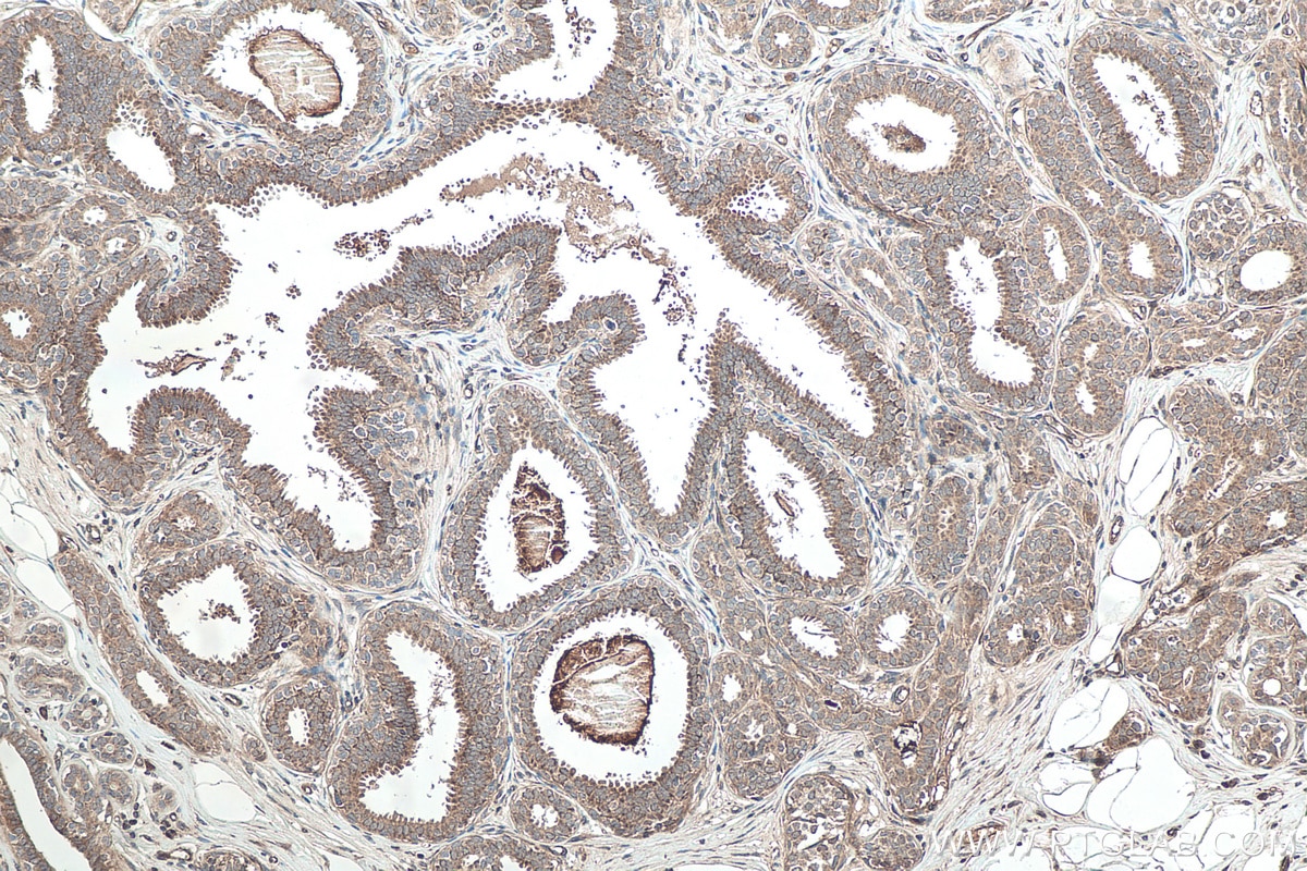 Immunohistochemistry (IHC) staining of human breast cancer tissue using TNC/Tenascin-C Polyclonal antibody (27789-1-AP)