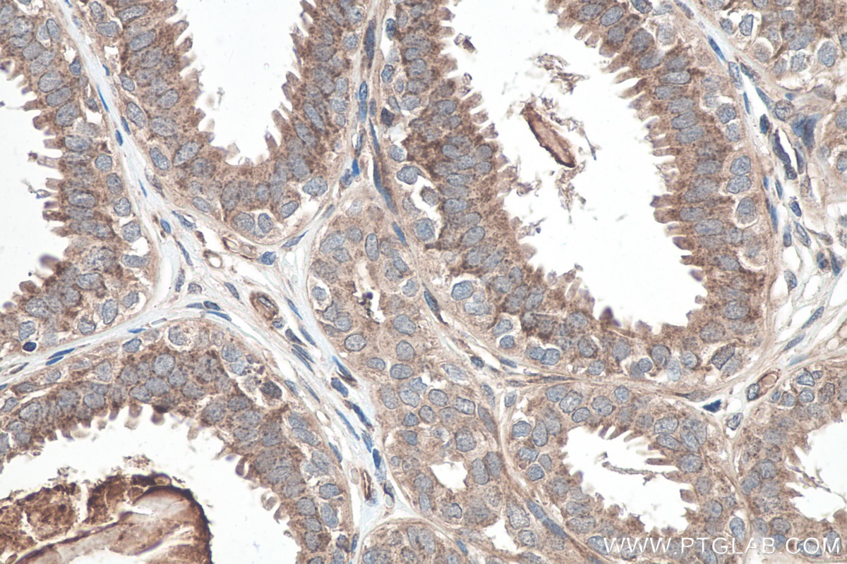 Immunohistochemistry (IHC) staining of human breast cancer tissue using TNC/Tenascin-C Polyclonal antibody (27789-1-AP)