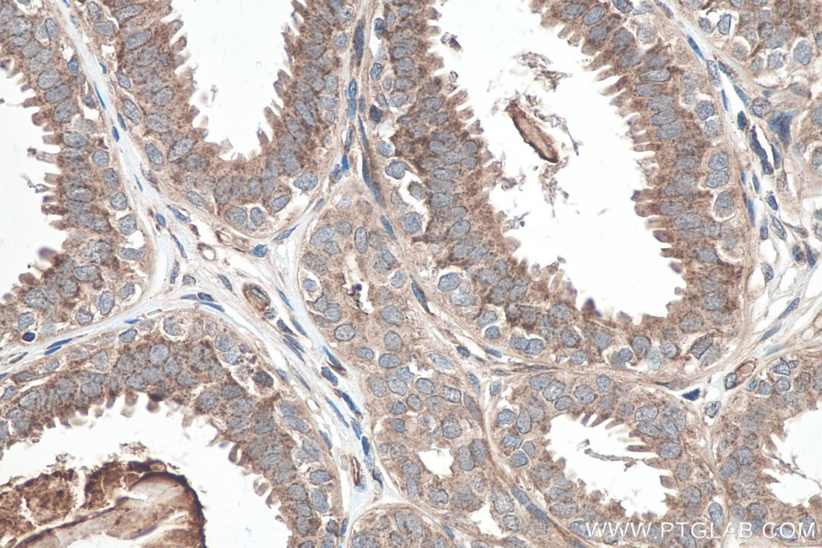 IHC staining of human breast cancer using 27789-1-AP