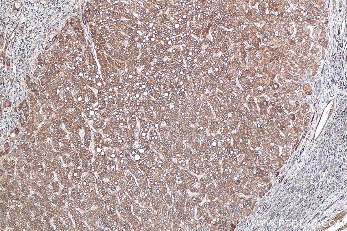 Immunohistochemistry (IHC) staining of human liver cancer tissue using TNC/Tenascin-C Polyclonal antibody (27789-1-AP)