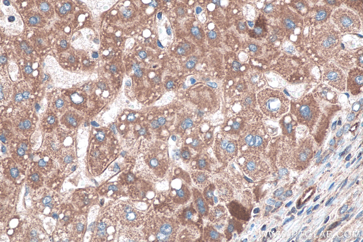 Immunohistochemistry (IHC) staining of human liver cancer tissue using TNC/Tenascin-C Polyclonal antibody (27789-1-AP)
