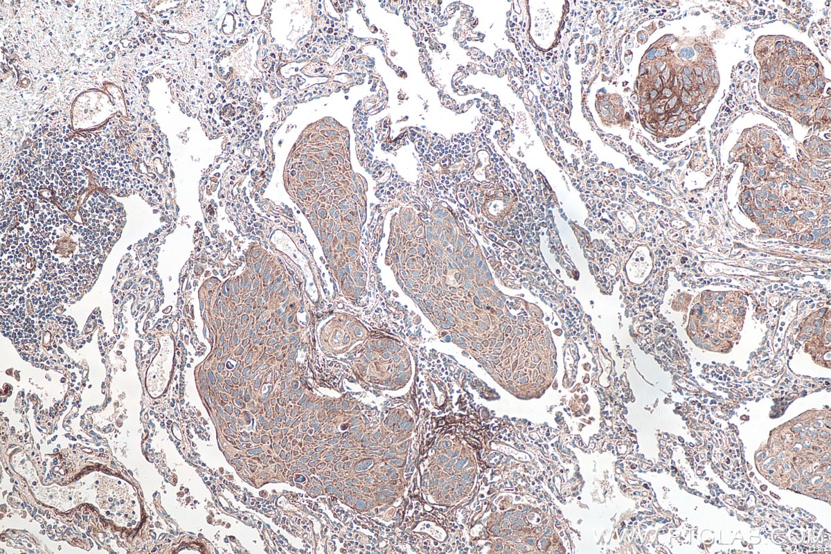 Immunohistochemistry (IHC) staining of human lung cancer tissue using TNC/Tenascin-C Polyclonal antibody (27789-1-AP)