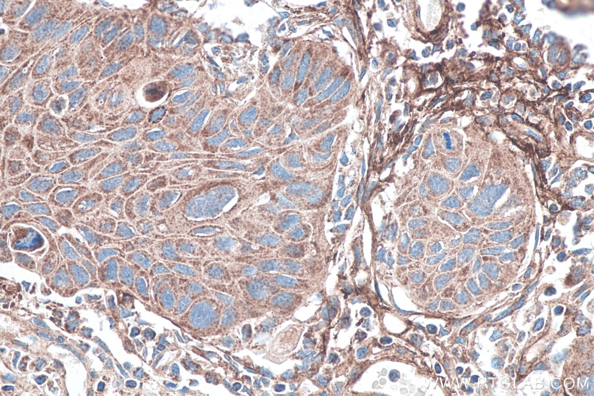 Immunohistochemistry (IHC) staining of human lung cancer tissue using TNC/Tenascin-C Polyclonal antibody (27789-1-AP)