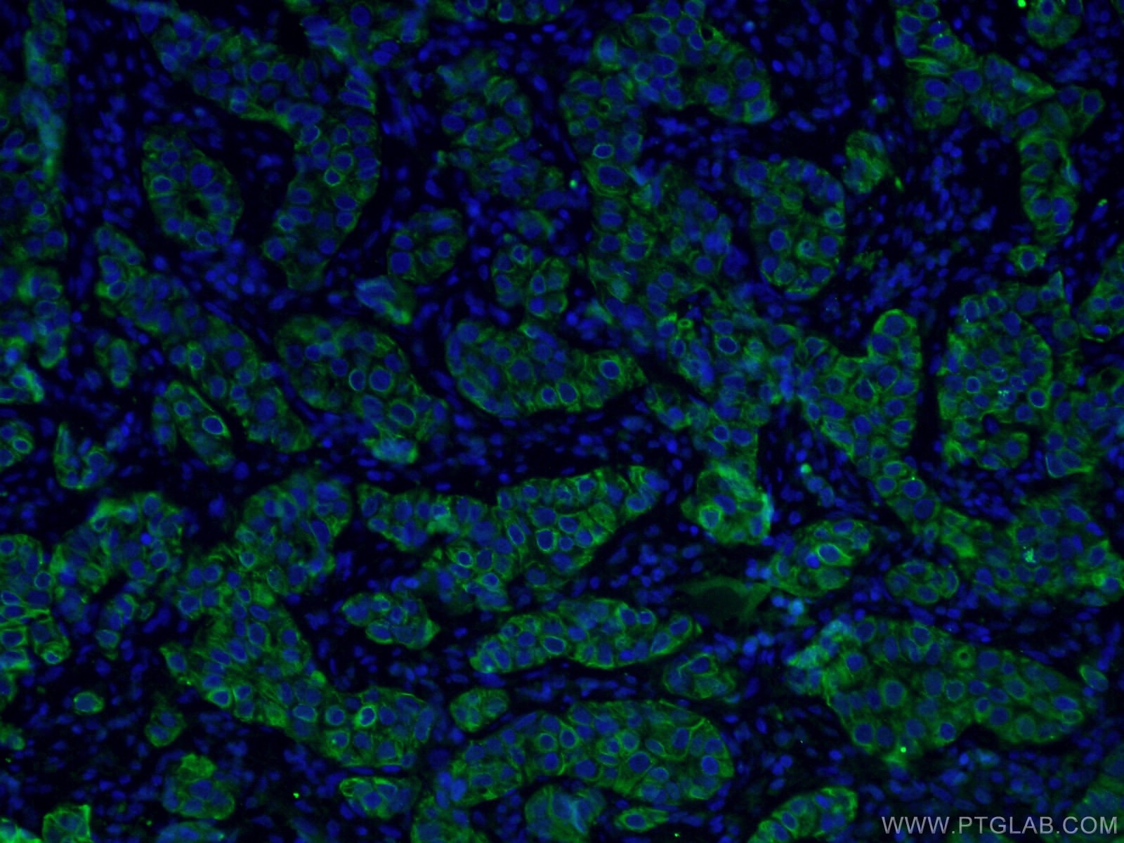 Immunofluorescence (IF) / fluorescent staining of human breast cancer tissue using TNF Alpha Monoclonal antibody (60291-1-Ig)