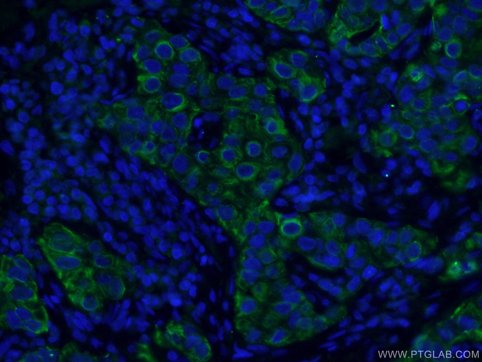 Immunofluorescence (IF) / fluorescent staining of human breast cancer tissue using TNF Alpha Monoclonal antibody (60291-1-Ig)