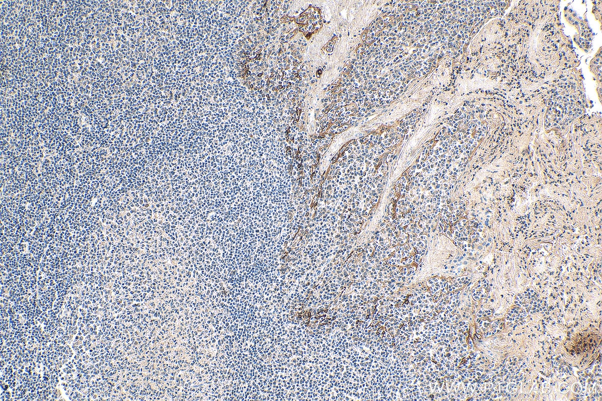 IHC staining of human tonsillitis using 60291-1-Ig