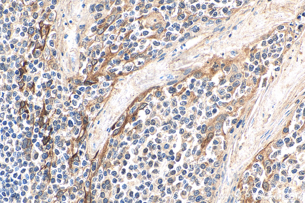 Immunohistochemistry (IHC) staining of human tonsillitis tissue using TNF Alpha Monoclonal antibody (60291-1-Ig)