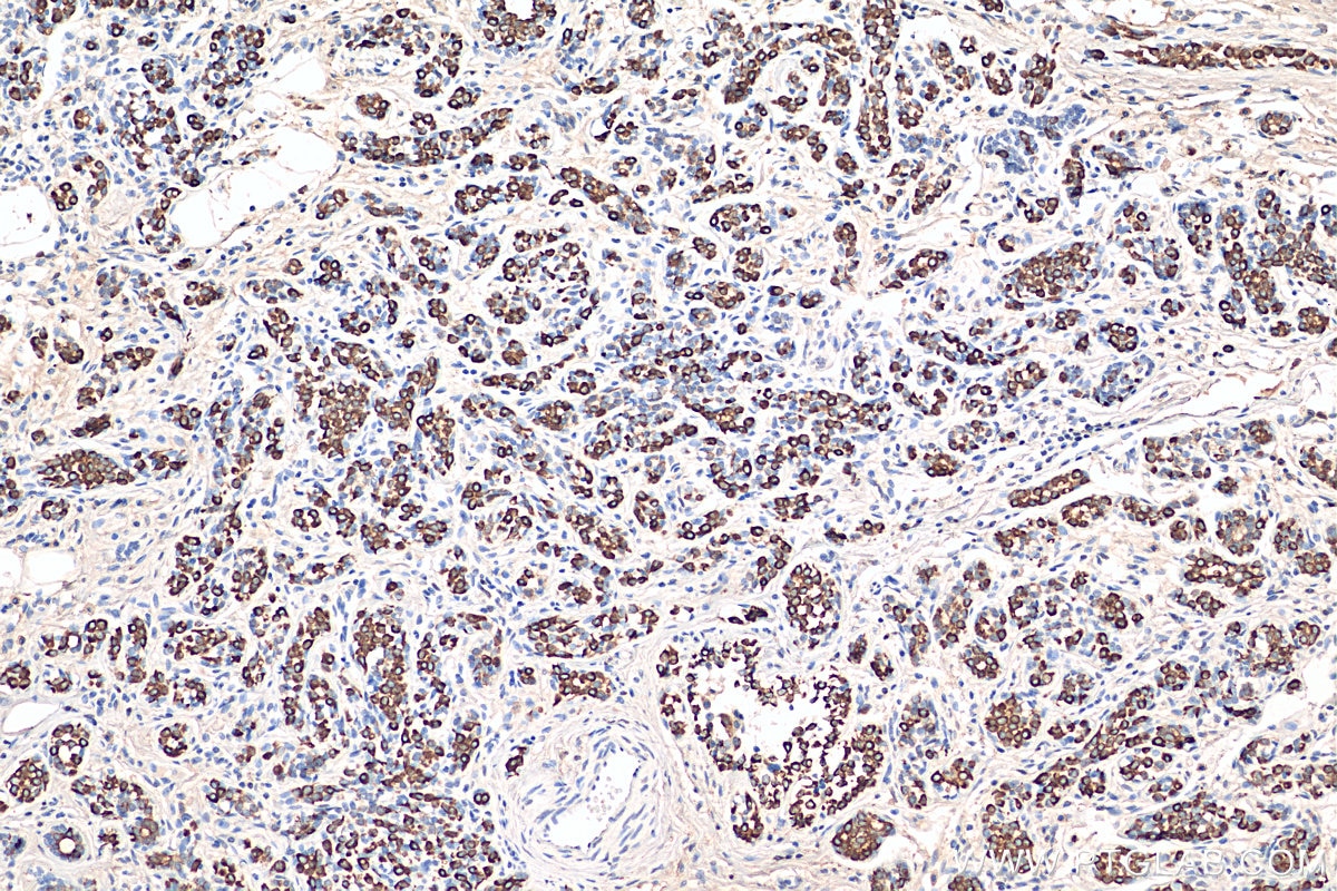 Immunohistochemistry (IHC) staining of human breast cancer tissue using TNF Alpha Monoclonal antibody (60291-1-Ig)