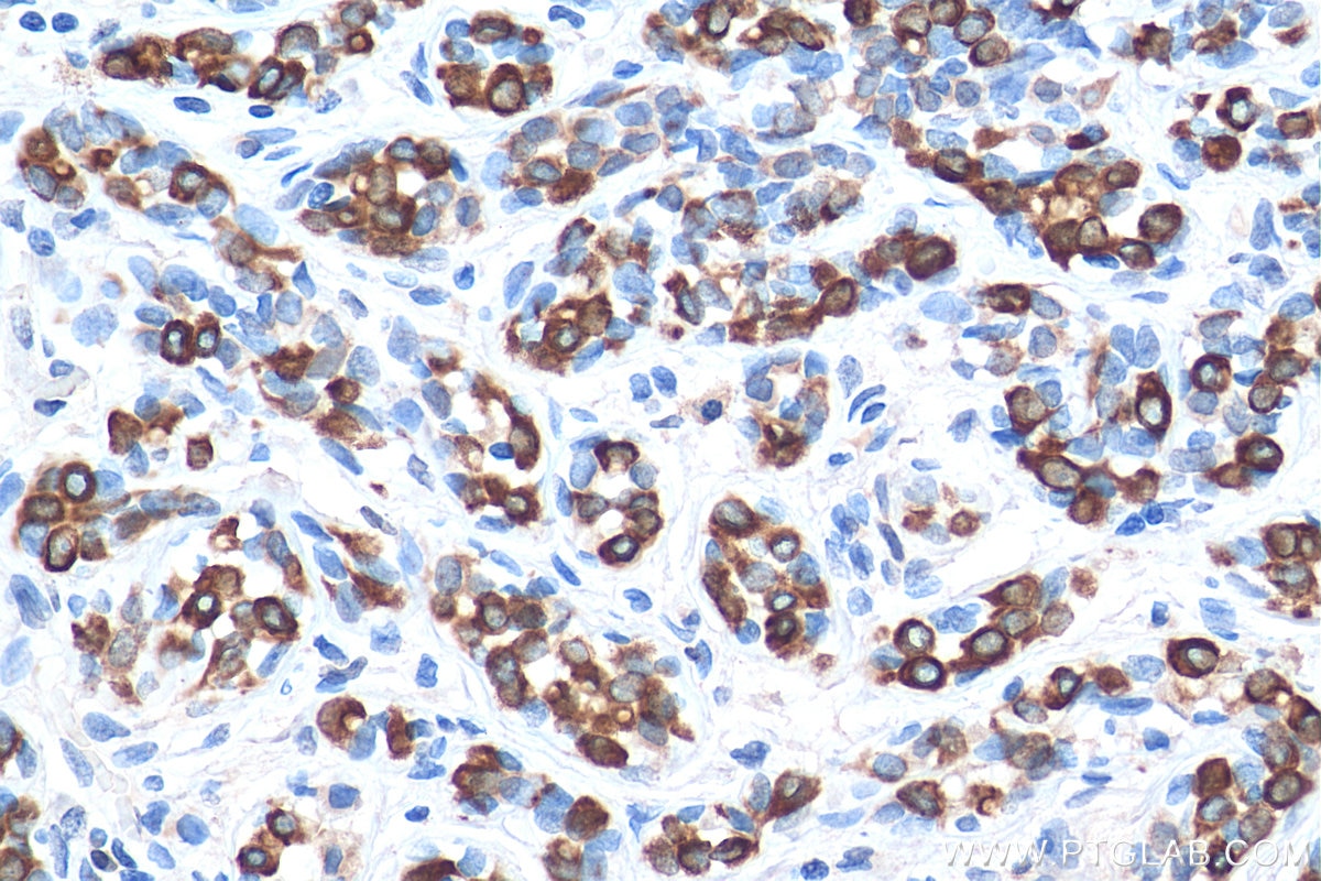 Immunohistochemistry (IHC) staining of human breast cancer tissue using TNF Alpha Monoclonal antibody (60291-1-Ig)