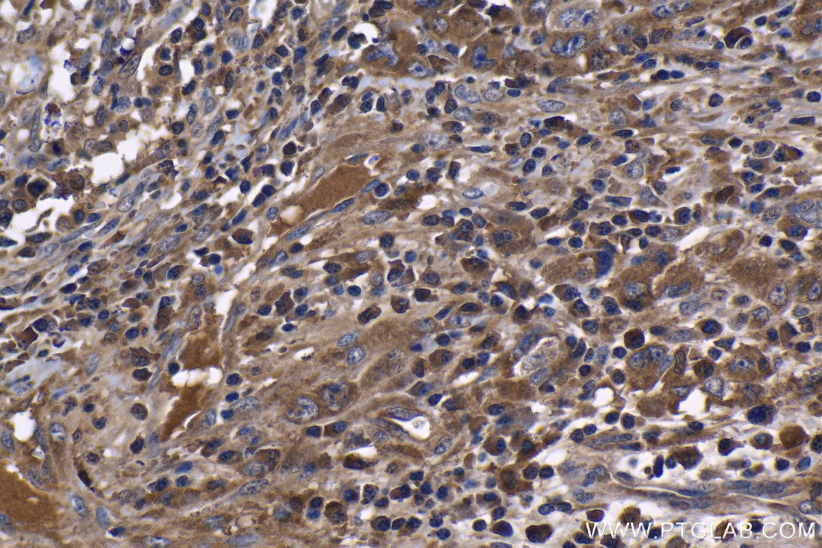Immunohistochemical analysis of paraffin-embedded human lymphoma tissue slide using 60291-1-Ig (TNF Alpha antibody) at dilution of 1:1000 (under 40x lens). Heat mediated antigen retrieval with Tris-EDTA buffer (pH 9.0). This data was developed using the same antibody clone with 60291-1-PBS in a different storage buffer formulation. Immunohistochemistry (IHC) staining of human lymphoma tissue using TNF-alpha Monoclonal antibody (60291-1-Ig)