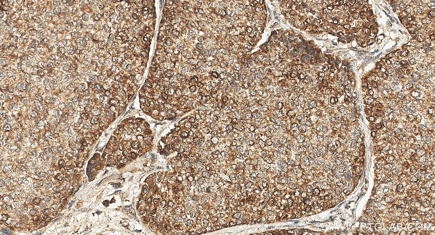 Immunohistochemistry (IHC) staining of human breast cancer tissue using TNF-alpha Monoclonal antibody (60291-1-Ig)