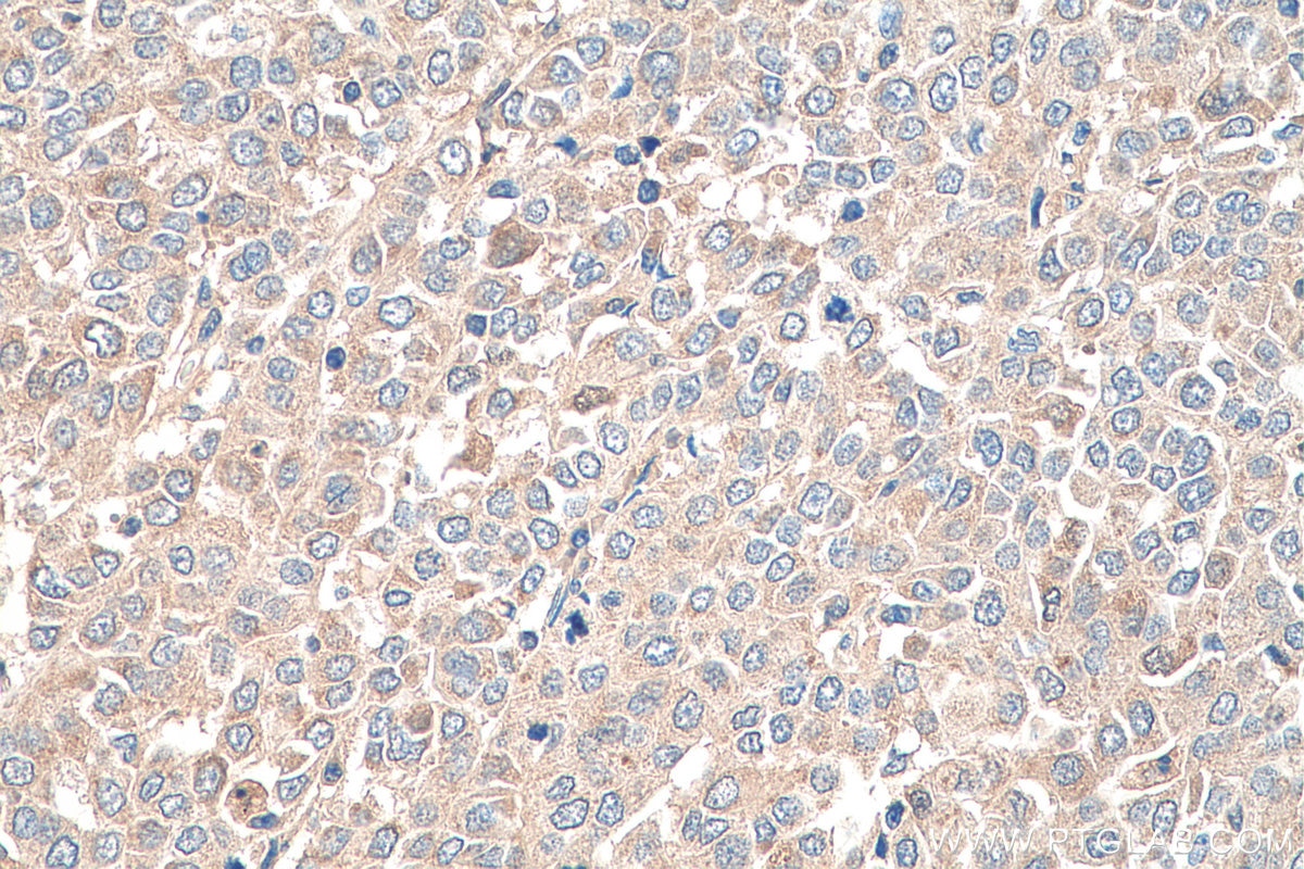 Immunohistochemistry (IHC) staining of human ovary tumor tissue using TNF Alpha Polyclonal antibody (26405-1-AP)
