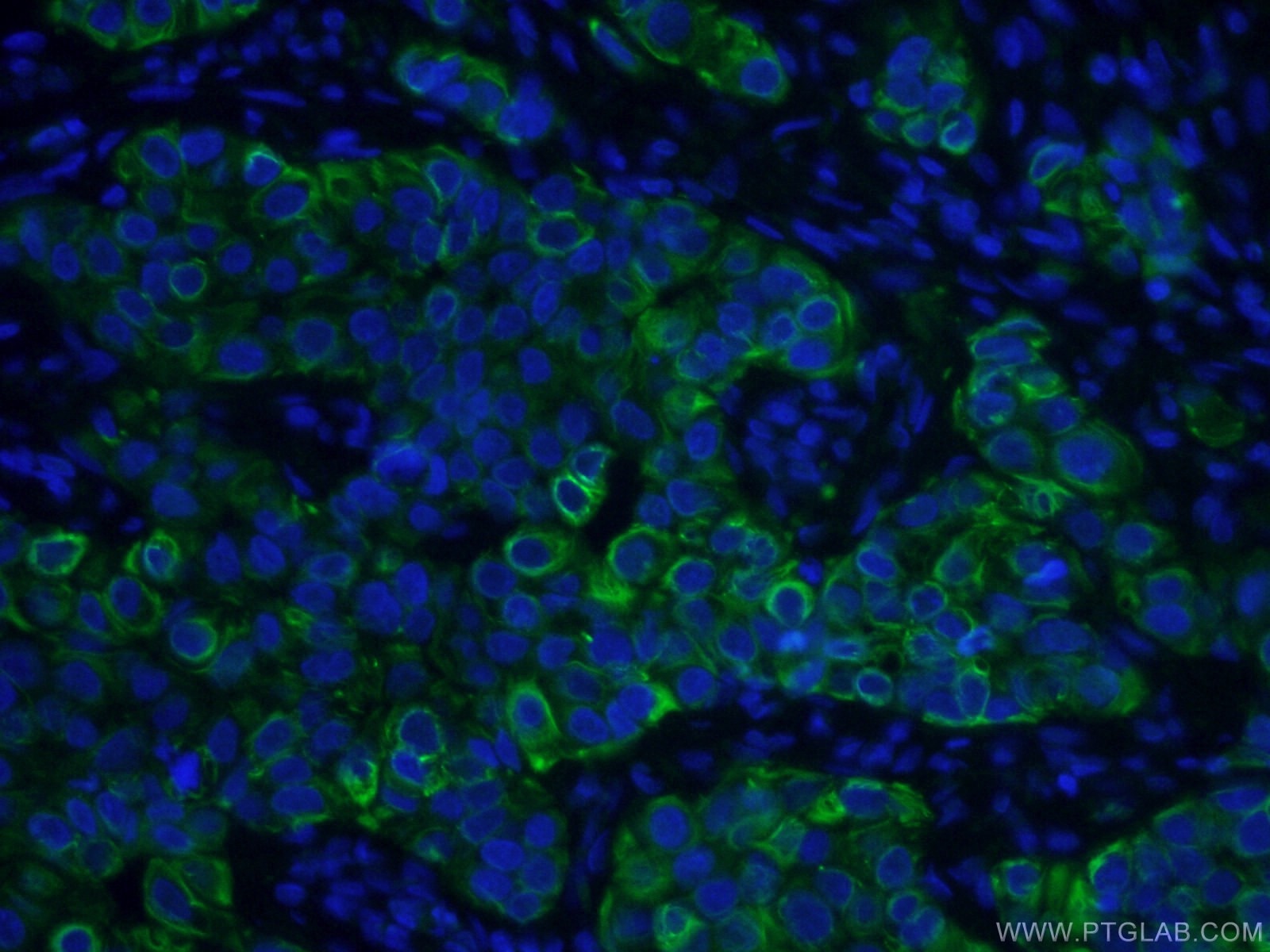 Immunofluorescence (IF) / fluorescent staining of human breast cancer tissue using CoraLite® Plus 488-conjugated TNF Alpha Monoclonal (CL488-60291)