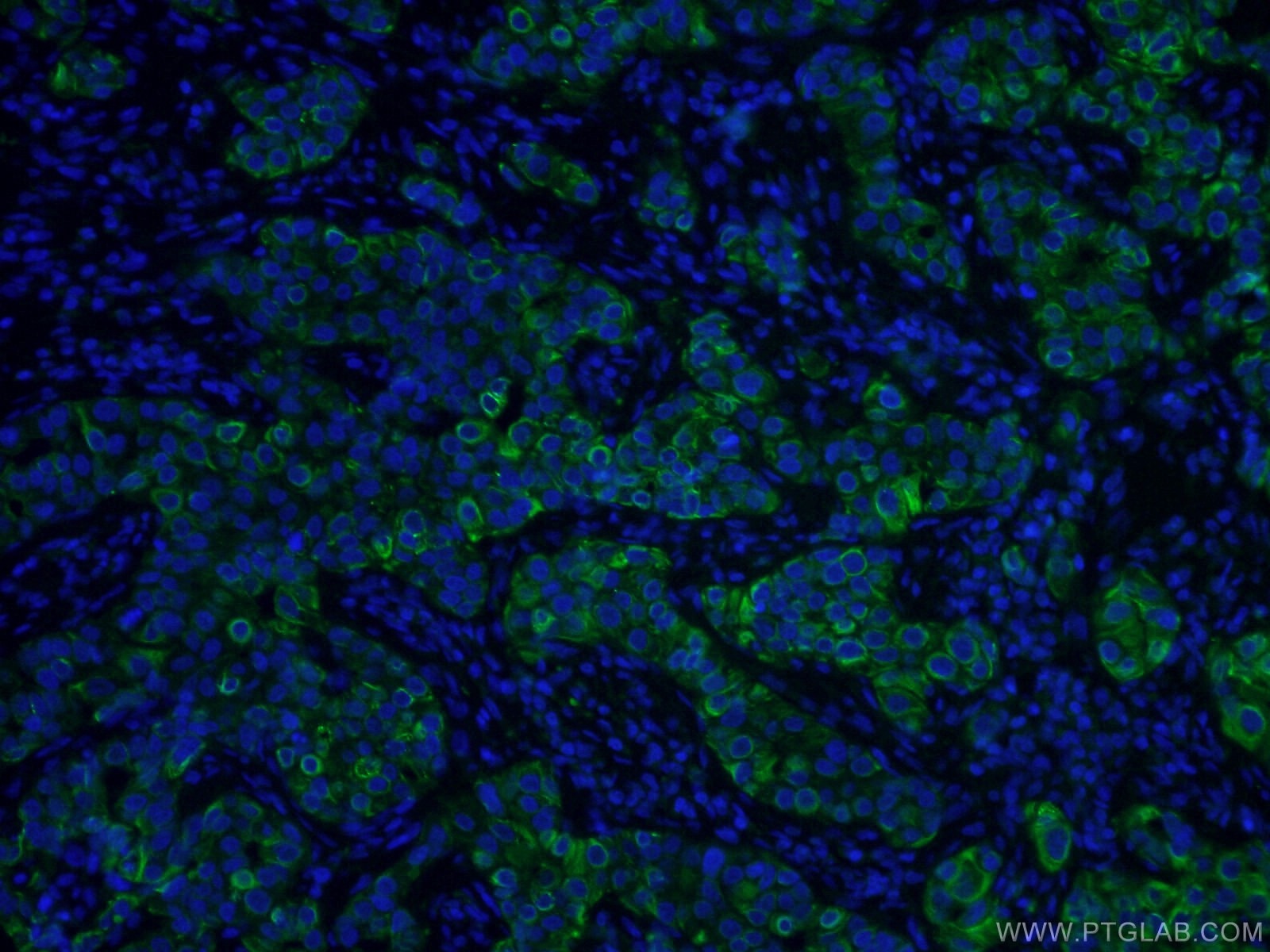 Immunofluorescence (IF) / fluorescent staining of human breast cancer tissue using CoraLite® Plus 488-conjugated TNF Alpha Monoclonal (CL488-60291)