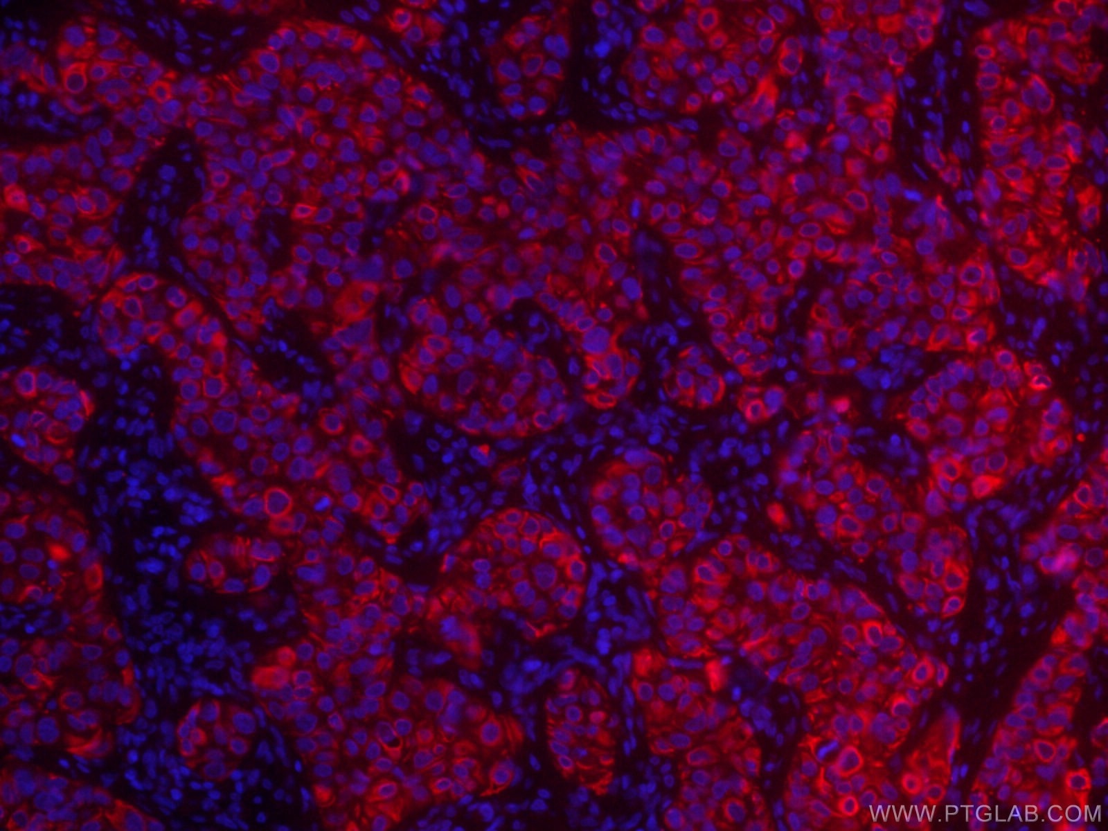 Immunofluorescence (IF) / fluorescent staining of human breast cancer tissue using CoraLite®594-conjugated TNF Alpha Monoclonal antib (CL594-60291)
